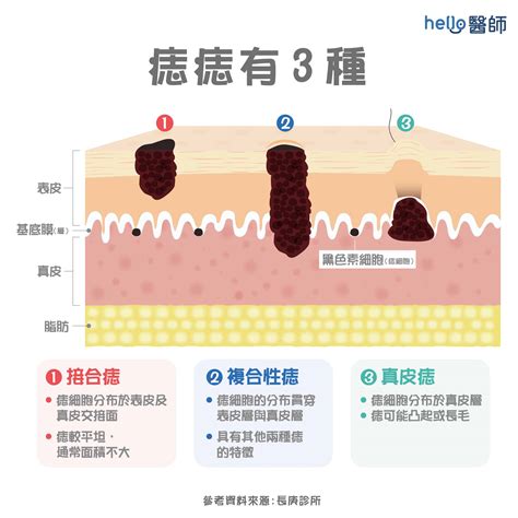 身體上的痣|痣形成的原因？痣長毛、痣變多變大是痣病變？5招判。